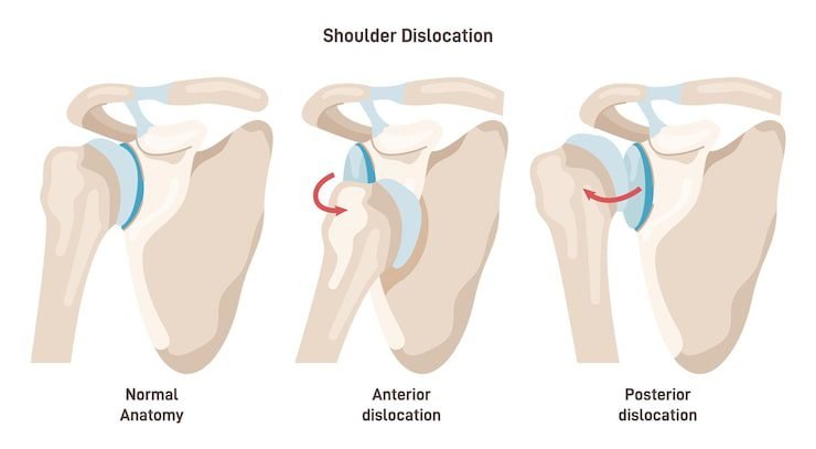 Physiotherapy for Frozen Shoulder